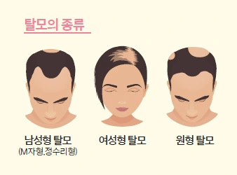 남성탈모-여성탈모