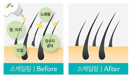 두피 스케일링